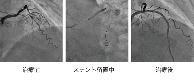 急性心筋梗塞の症例