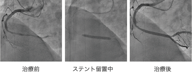 不安定狭心症の症例