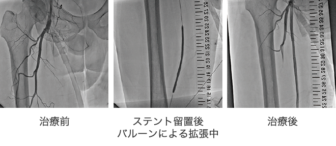 急性心筋梗塞の症例